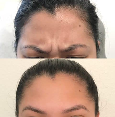 Woman's forehead showing fewer lines and wrinkles after Botox treatment.