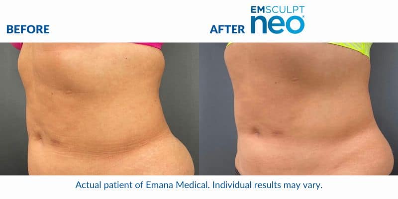 Woman's abdomen showing less fat and more muscle tone after Emsculpt NEO treatment.