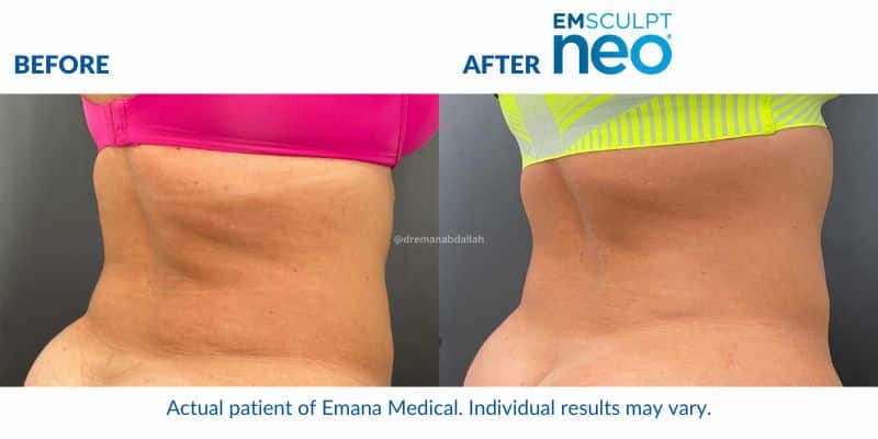 Woman's back and sides showing less fat and more muscle tone after Emsculpt NEO treatment.