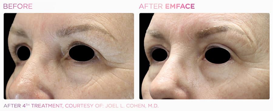 Woman's brow area showing more lifted, firmer skin after EMface treatment.
