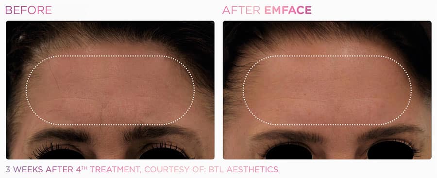 Woman's forehead showing fewer lines and wrinkles after EMface non-surgical face lift treatment.