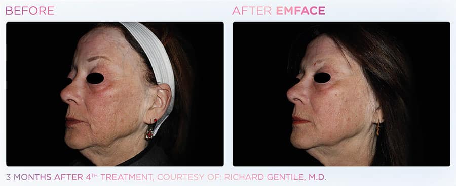 Woman's full face showing the benefits of non-invasive Emface treatment.