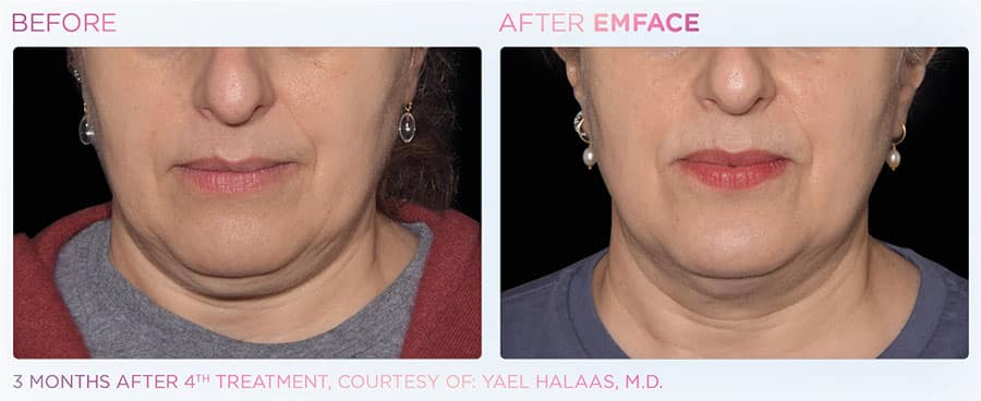 Woman's double chin before and after EMface non-surgical facelift treatment.