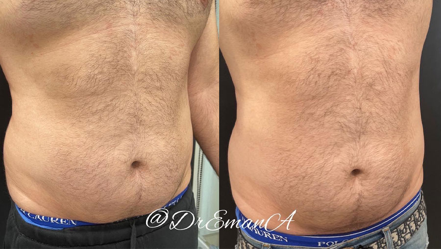 Man's abdomen showing more fat before and less fat and more muscle tone after Evolve treatment.