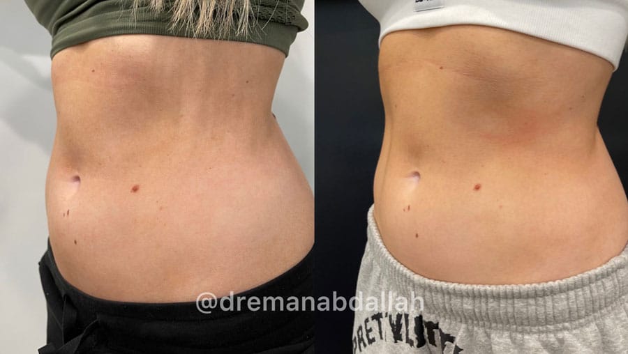 Woman's abdomen showing more fat before and less fat and more muscle tone after Evolve treatment.