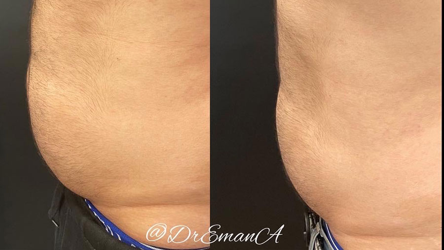 Man's abdomen showing more fat before and less fat and more muscle tone after Evolve treatment.