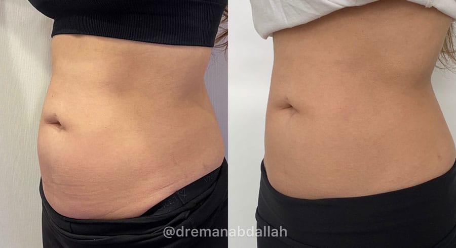 Woman's abdomen showing more fat before and less fat and more muscle tone after Evolve treatment.