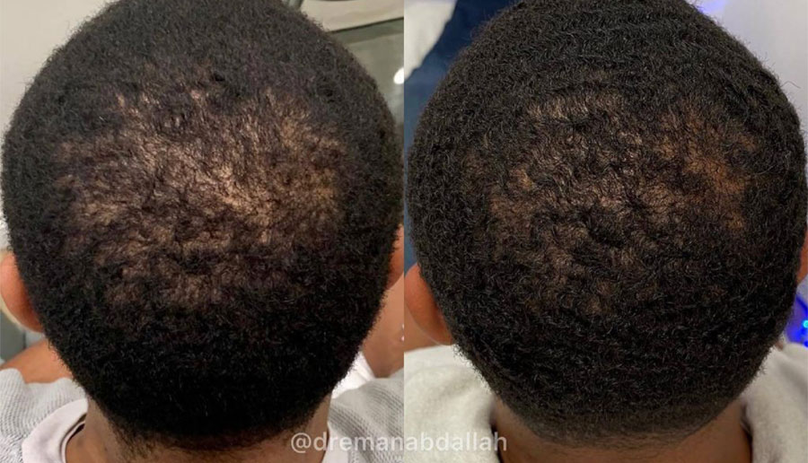 Man's scalps showing thinning hair on the crown before and fuller, thicker hair after hair restoration treatment.