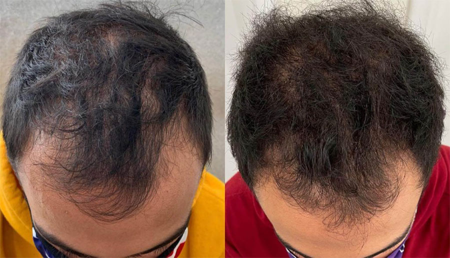 Man's scalp showing thinning hair before and fuller hair after hair restoration treatment.