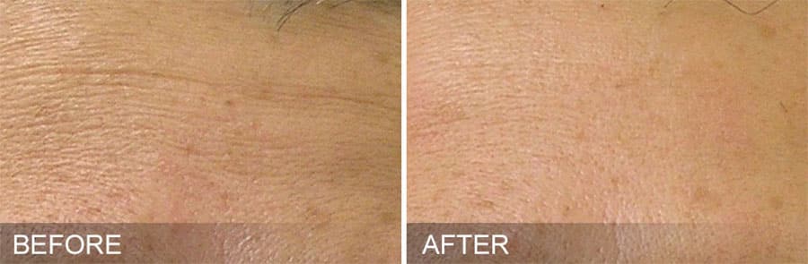 Forehead showing fine lines and wrinkles before and smoother skin after Hydrafacial treatment.