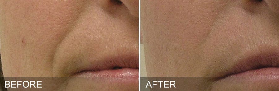 Woman's lip area showing before and after results of Hydrafacial treatment.