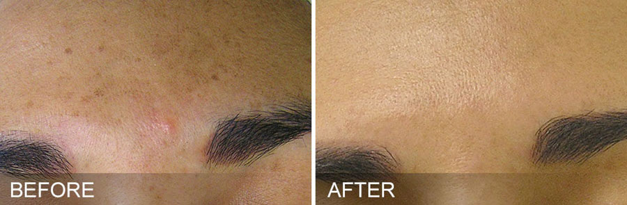 Woman's forehead showing before and after results of Hydrafacial treatment.