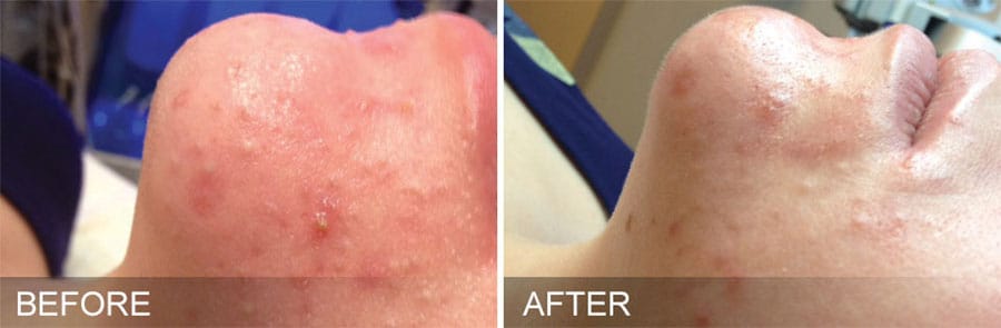 Woman's chin showing redness before and clearer, brighter skin after Hydrafacial treatment.