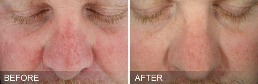 Man's face showing redness before and clearer, brighter skin after Hydrafacial treatment.