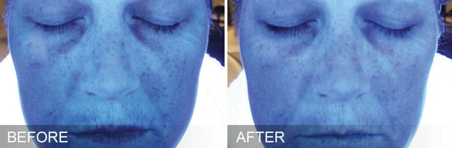 Woman's face showing hyperpigmentation and sun damage before and smoother, more even toned skin after Hydrafacial treatment.