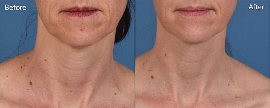 Woman's neck and chest area showing before and after results from Microneedling treatment.