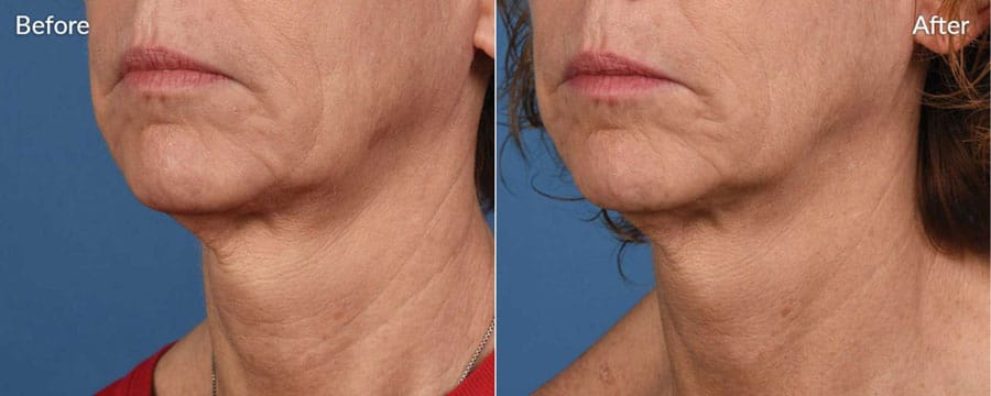 Woman's neck area showing before and after results from Microneedling treatment.