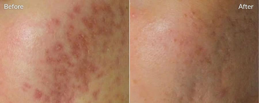 Woman's cheek showing a more even skin tone after microneedling treatment.