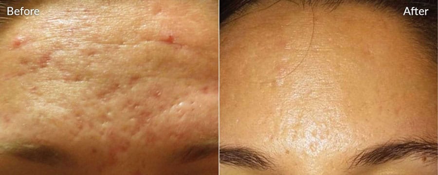 Woman's forehead showing improved appearance of acne scars after Microneedling treatment.