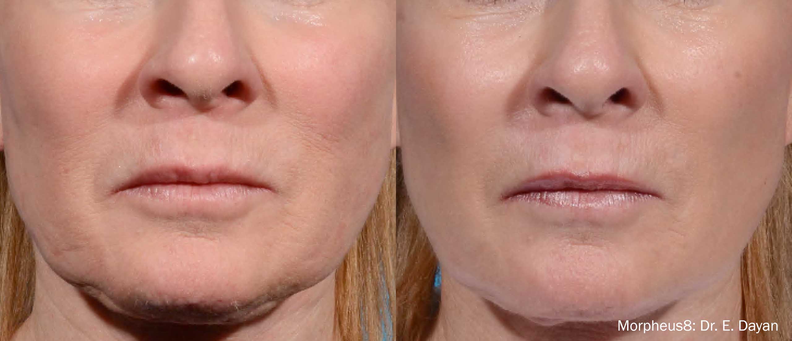Woman's face shows tighter skin around the mouth after Morepheus 8 treatment.