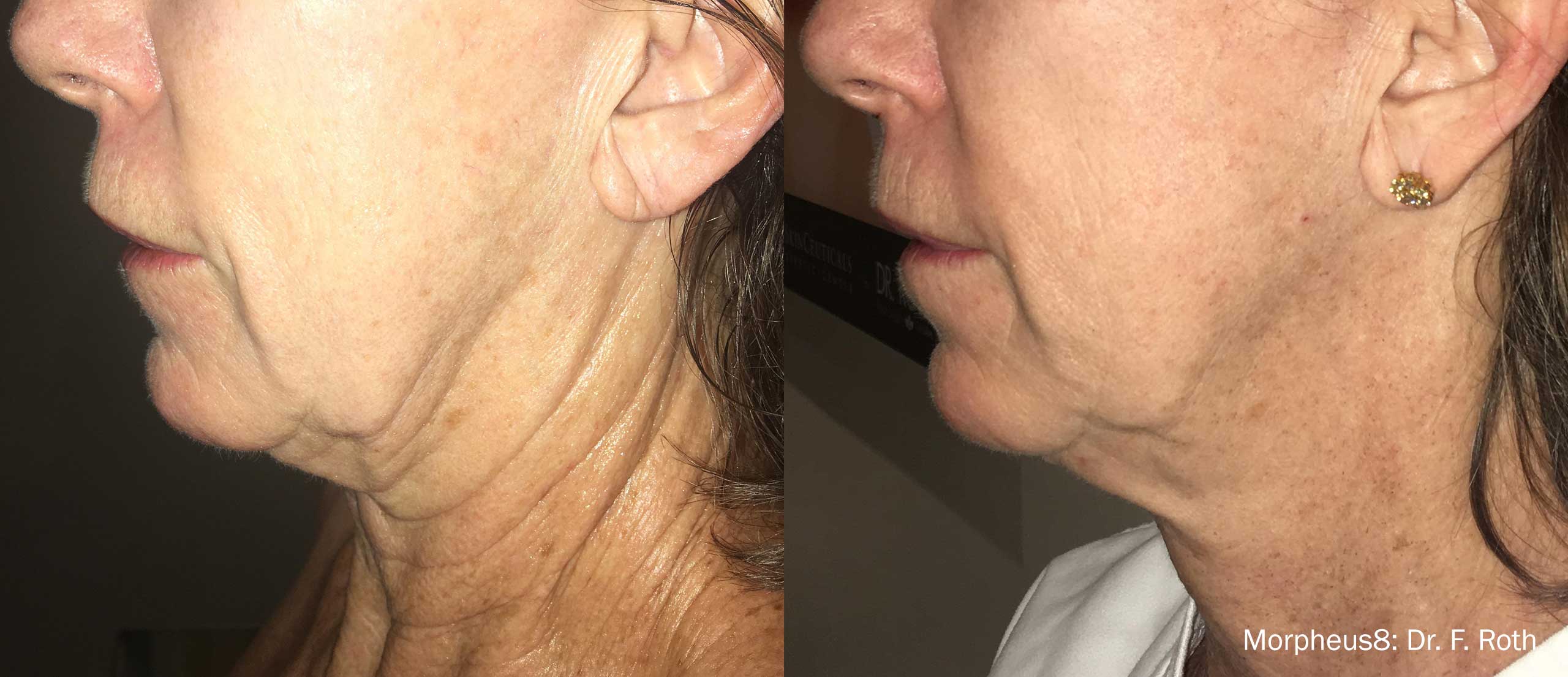 Woman's neck shows loose, wrinkled skin before and smoother, tighter skin after Morepheus 8 treatment.