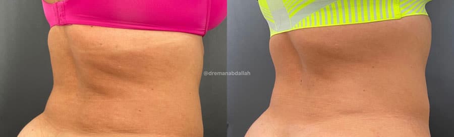 Woman's back showing more fat and looser skin before and tighter, more sculpted skin after EMtone treatment.