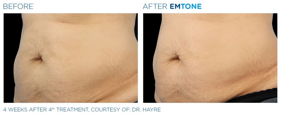 Woman's stomach showing sagging skin before and tighter skin after EMtone treatment.