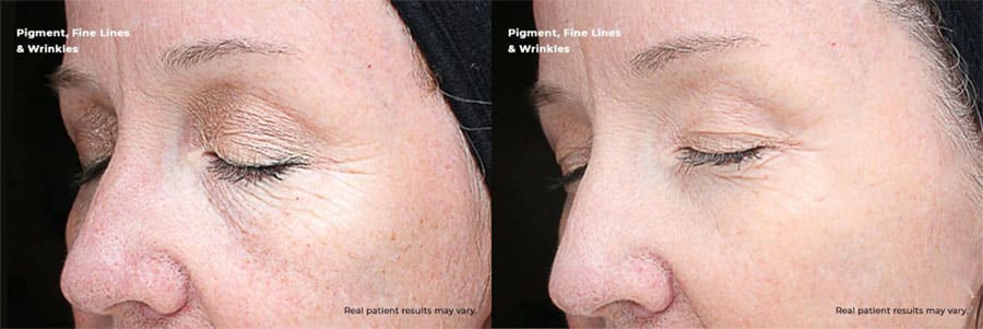 Woman's cheek and eye area showing improved skin tone and texture after a VI peel.
