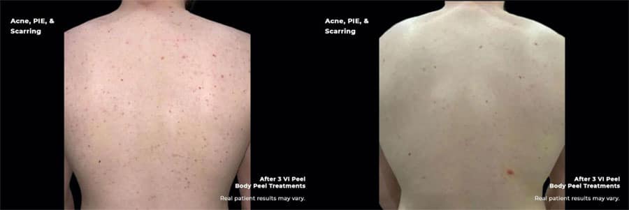 Man's back showing before and after results of VI Chemical Peels.