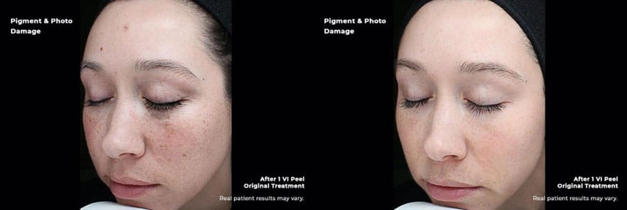 Woman's face showing before and after results of VI chemical peels.