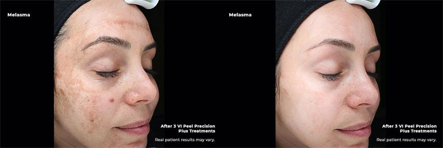 Woman's face showing uneven skin tone before and clearer, brighter skin after a VI chemical peel.