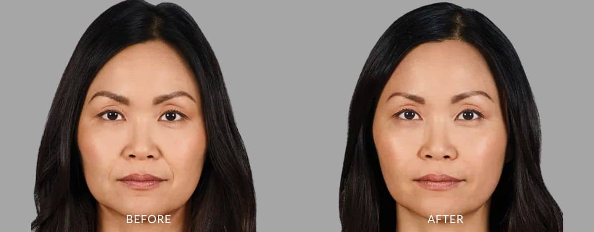 dermal fillers before and after photos (1)