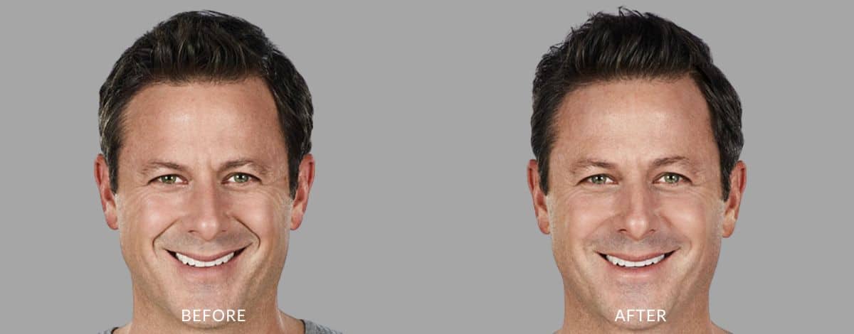 Before and after photos of dermal fillers on a man's face showing a reduced wrinkles.