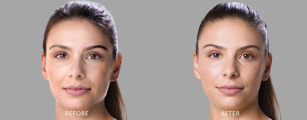 dermal fillers before and after photos (4)