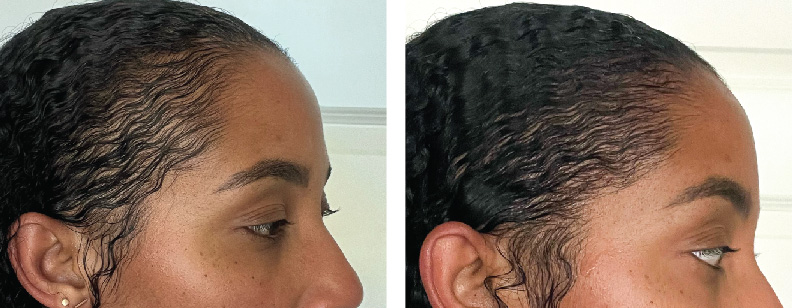 before and after photos of a woman treated with BENEV exosomes, resulting in improved hair density and thickness in Beverly Hills, CA