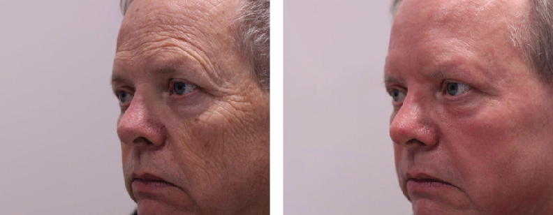before and after photos of a man treated with BENEV exosomes, resulting in youthful and rejuvenated skin in Beverly Hills, CA