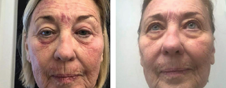 before and after photos of a woman treated with BENEV exosomes for skin rejuvenation treatment in Beverly Hills, CA