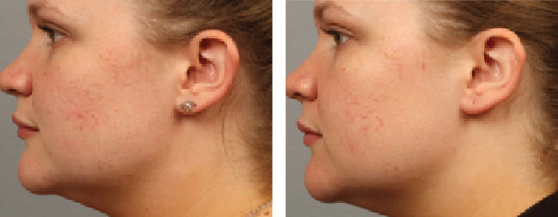 Before and after photos of a woman in Beverly Hills, CA who was treated with BENEV exosomes for skin rejuvenation.