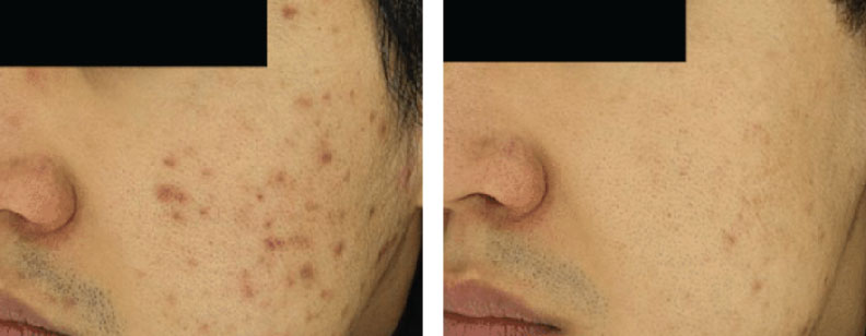 before and after photos of a male treated with BENEV exosomes for acne scars in Beverly Hills, CA