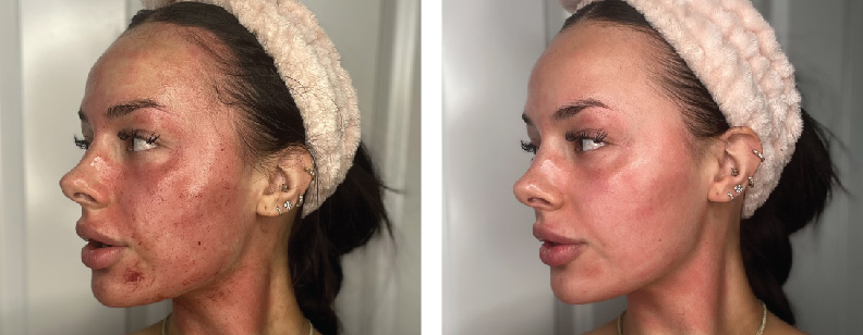 before and after images of a lady treated with BENEV exosomes for skin rejuvenation in Beverly Hills, CA