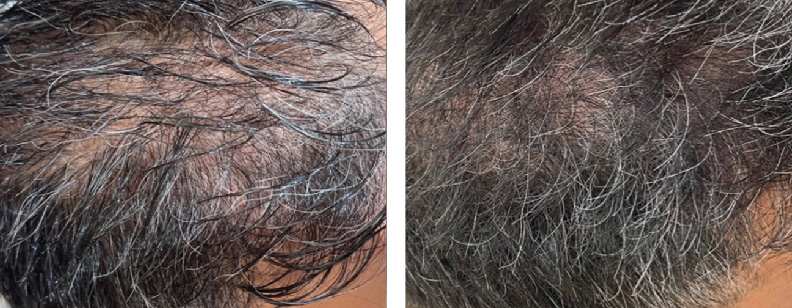 before and after photos of a scalp treated with BENEV exosomes, resulting in improved hair density and thickness in Beverly Hills, CA