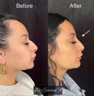 Liquid Rhinoplasty Before and After 3-Emana Medical-Beverly Hills, CA