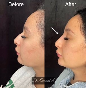Liquid Rhinoplasty Before and After 2-Emana Medical-Beverly Hills, CA